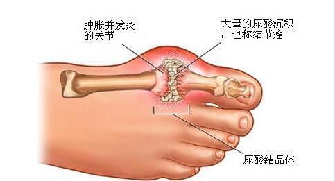 秋冬季節(jié)小心痛風(fēng)，在飲食方面該注意些什么？