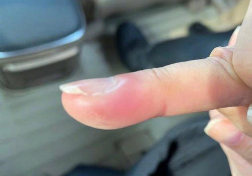 別隨便拔倒刺 這一行為可能讓你進(jìn)醫(yī)院