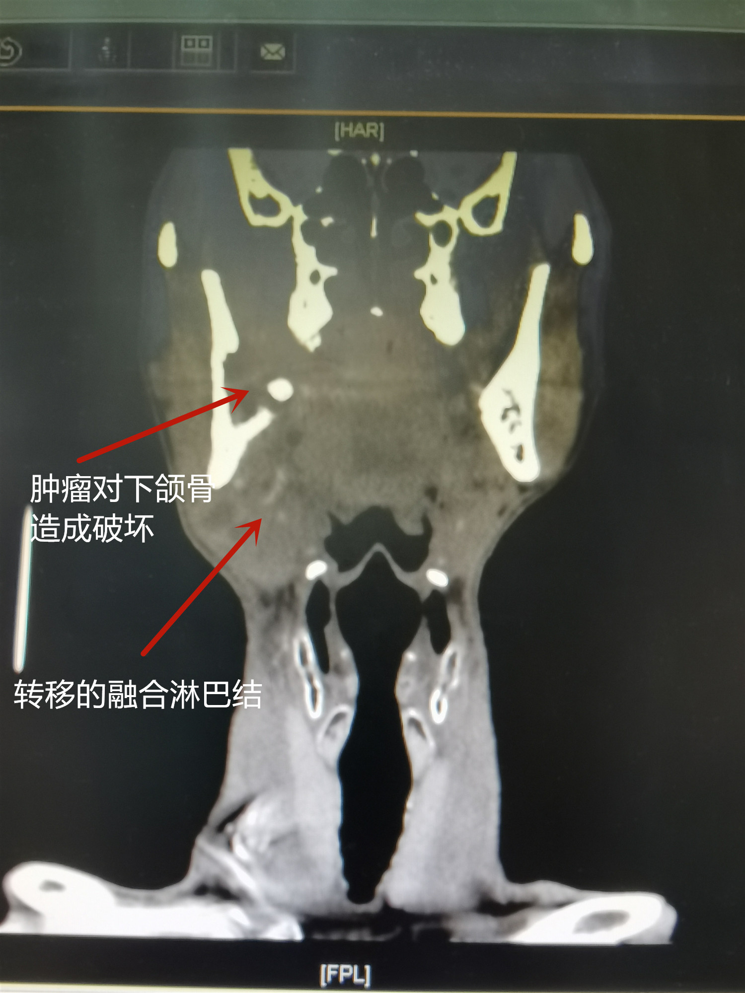 吃藥也不管用？警惕遷延不治的牙疼“成為”口腔癌